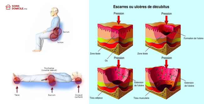 escarres-infirmiers-prevention escarres-infirmiers-prevention