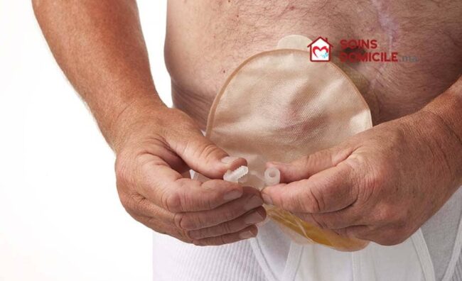 Urostomie Soins Infirmiers Urostomie Soins Infirmiers