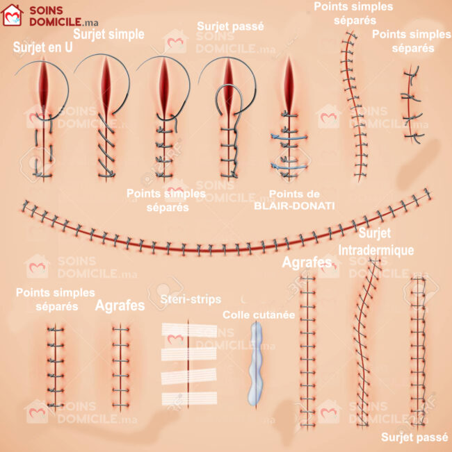 types de points de sutures types de points de sutures