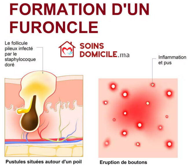 Furoncle purulent soins à domicile Furoncle purulent soins à domicile